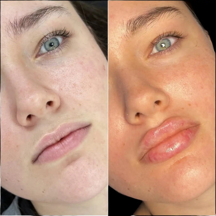 How to Choose the Right Clinic for Fillers in Dubai