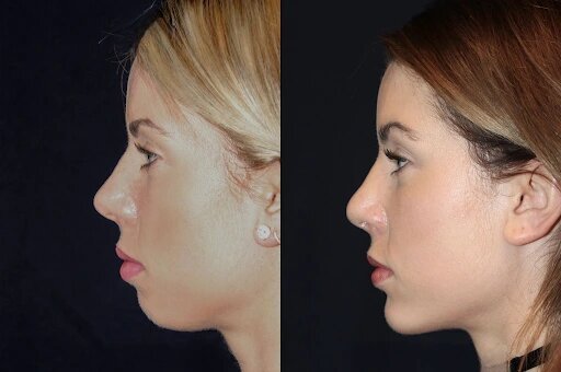 Chin Fillers in Dubai: Everything You Need to Know About the Procedure and Costs